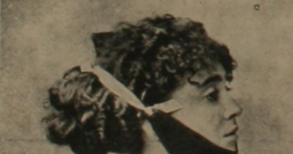 Ortopedia casera para quitar la doble barba, 1911